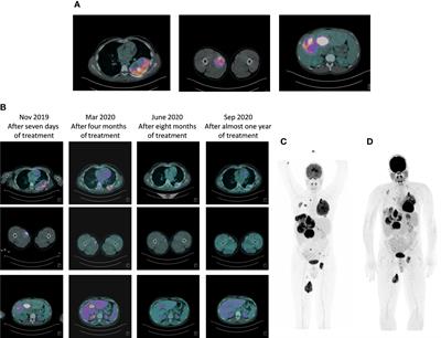 Case Report: Adult NTRK-Rearranged Spindle Cell Neoplasm: Early <mark class="highlighted">Tumor Shrinkage</mark> in a Case With Bone and Visceral Metastases Treated With Targeted Therapy